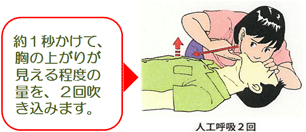 イラスト:人工呼吸