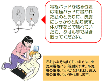 イラスト:電極パッドを張る女性